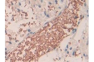 Detection of BND3 in Human Glioma Tissue using Polyclonal Antibody to Band 3 (BND3)