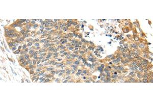 Immunohistochemistry of paraffin-embedded Human esophagus cancer tissue using TNFAIP8 Polyclonal Antibody at dilution 1:35 (TNFAIP8 anticorps)