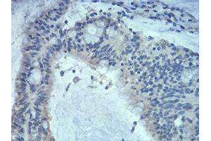 Immunohistochemical analysis of paraffin-embedded colon cancer tissues using Rab5a mouse mAb with DAB staining. (RAB5 anticorps  (AA 1-215))