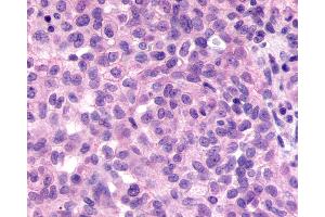 Anti-GPR98 / VLGR1 antibody IHC of human Ovary, Carcinoma. (ADGRV1 / GPR98 anticorps  (N-Term))