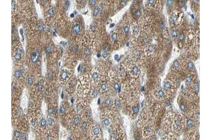 ABIN6266590 at 1/100 staining human liver carcinoma tissue sections by IHC-P.