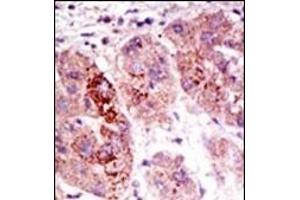 Formalin-fixed and paraffin-embedded human cancer tissue reacted with the primary antibody, which was peroxidase-conjugated to the secondary antibody, followed by AEC staining.