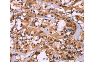 Immunohistochemistry of Human thyroid cancer using HIST1H1C Polyclonal Antibody at dilution of 1:70 (HIST1H1C anticorps)