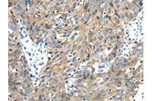 The image on the left is immunohistochemistry of paraffin-embedded Human breast cancer tissue using ABIN7131402(TMPRSS13 Antibody) at dilution 1/30, on the right is treated with fusion protein. (TMPRSS13 anticorps)