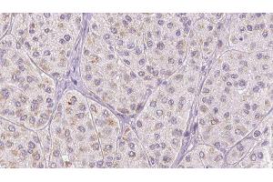 ABIN6278027 at 1/100 staining Human melanoma tissue by IHC-P. (FGA anticorps  (C-Term))