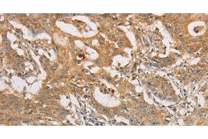 Immunohistochemistry of paraffin-embedded Human gastric cancer tissue using ARSG Polyclonal Antibody at dilution 1:30 (ARSG anticorps)