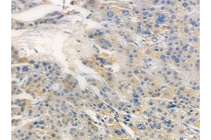ABIN6259003 and ABIN6276118 at 1/100 staining human hepatocellular carcinoma by IHC-P.