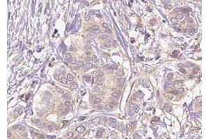ABIN6275873 at 1/100 staining Human breast cancer tissue by IHC-P. (HMMR anticorps  (Internal Region))
