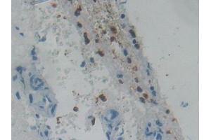 Detection of RNASE3 in Human Glioma Tissue using Polyclonal Antibody to Ribonuclease A3 (RNASE3)