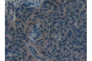 Detection of Hepc in Human Esophagus cancer Tissue using Polyclonal Antibody to Hepcidin (Hepc)