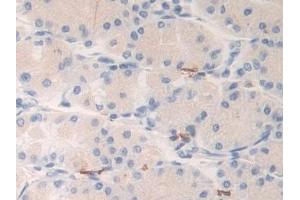 Detection of KLK6 in Human Stomach cancer Tissue using Polyclonal Antibody to Kallikrein 6 (KLK6)