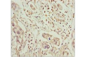 Immunohistochemistry of paraffin-embedded human pancreatic cancer using ABIN7159626 at dilution of 1:100