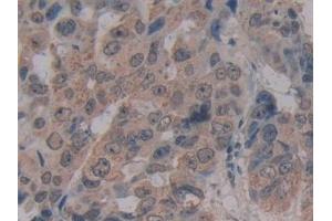 Detection of MFAP2 in Human Breast cancer Tissue using Polyclonal Antibody to Microfibrillar Associated Protein 2 (MFAP2)