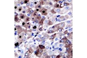 Immunohistochemical analysis of XPC staining in human liver cancer formalin fixed paraffin embedded tissue section. (XPC anticorps)