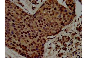 IHC image of ABIN7168396 diluted at 1:500 and staining in paraffin-embedded human pancreatic cancer performed on a Leica BondTM system. (Raly anticorps  (AA 254-306))