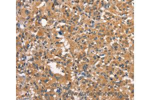 Immunohistochemistry of Human thyroid cancer using DNM2 Polyclonal Antibody at dilution of 1:40 (DNM2 anticorps)