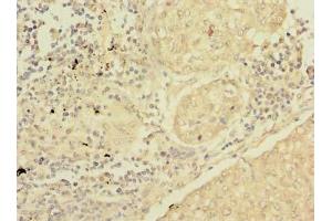 Immunohistochemistry of paraffin-embedded human lung cancer using ABIN7166622 at dilution of 1:100