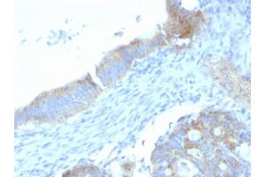 Formalin-fixed, paraffin-embedded human Colon Carcinoma stained with Heparan Sulfate Monoclonal Antibody (SPM255). (HSPG2 anticorps)