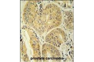 EN Antibody (C-term) (ABIN652020 and ABIN2840500) immunohistochemistry analysis in formalin fixed and paraffin embedded human prostate carcinoma followed by peroxidase conjugation of the secondary antibody and DAB staining. (Enamelin anticorps  (C-Term))
