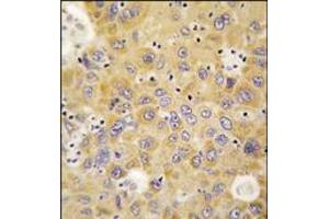 Formalin-fixed and paraffin-embedded human hepatocarcinoma tissue reacted with AARS antibody (N-term), which was peroxidase-conjugated to the secondary antibody, followed by DAB staining.