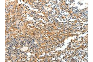 The image on the left is immunohistochemistry of paraffin-embedded Human tonsil tissue using ABIN7129267(DTX3 Antibody) at dilution 1/20, on the right is treated with fusion protein. (Deltex Homolog 3 anticorps)