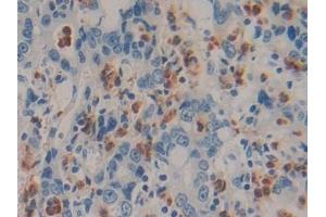 Detection of IL6 in Human Stomach cancer Tissue using Monoclonal Antibody to Interleukin 6 (IL6)