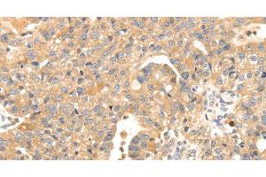 Immunohistochemistry of paraffin-embedded Human breast cancer tissue using S100A12 Polyclonal Antibody at dilution 1:45