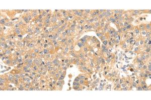 Immunohistochemistry of paraffin-embedded Human breast cancer tissue using S100A12 Polyclonal Antibody at dilution 1:45 (S100A12 anticorps)
