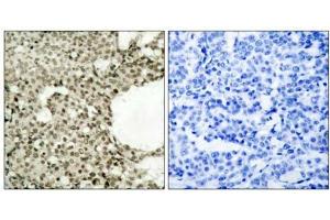 Immunohistochemical analysis of paraffin-embedded human breast carcinoma tissue using STAT1 (phospho- Ser727) antibody (E011163). (STAT1 anticorps  (pSer727))