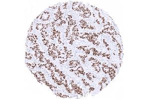 Strong INSM1 immunostaining in a low grade neuroendocrine tumor of the appendix