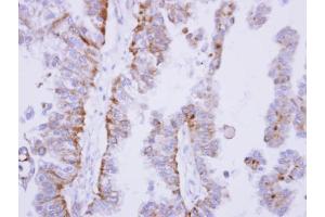 IHC-P Image Immunohistochemical analysis of paraffin-embedded OVCA xenograft, using SHP1, antibody at 1:100 dilution. (SHP1 anticorps)