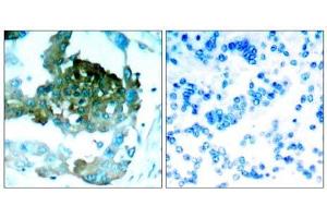 Immunohistochemical analysis of paraffin-embedded human lung carcinoma tissue, using PKCθ (Ab-695) antibody (E021185). (PKC theta anticorps)