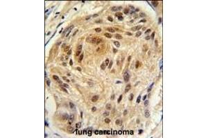 Formalin-fixed and paraffin-embedded human lung carcinoma tissue reacted with LSM1 antibody (C-term) (ABIN389386 and ABIN2839481) , which was peroxidase-conjugated to the secondary antibody, followed by DAB staining.