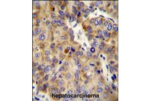 COL18A1 Antibody immunohistochemistry analysis in formalin fixed and paraffin embedded human hepatocarcinoma followed by peroxidase conjugation of the secondary antibody and DAB staining. (COL18A1 anticorps  (AA 1311-1339))