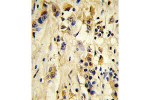 Formalin-fixed and paraffin-embedded human breast carcinoma reacted with EIF4E2 Antibody, which was peroxidase-conjugated to the secondary antibody, followed by DAB staining. (EIF4E2 anticorps)
