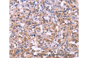 Immunohistochemistry of Human thyroid cancer using MMP14 Polyclonal Antibody at dilution of 1:40 (MMP14 anticorps)
