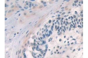 Detection of SOCS2 in Human Skin cancer Tissue using Polyclonal Antibody to Suppressors Of Cytokine Signaling 2 (SOCS2)