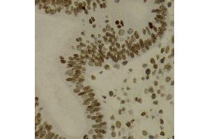Immunohistochemistry of paraffin-embedded human uterine cancer using NFKB2 Antibody.
