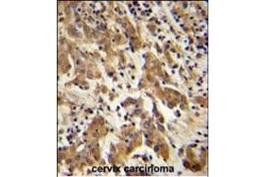 GK Antibody (C-term) (ABIN651665 and ABIN2840349) immunohistochemistry analysis in formalin fixed and paraffin embedded human cervix carcinoma followed by peroxidase conjugation of the secondary antibody and DAB staining. (GKAP1 anticorps  (C-Term))