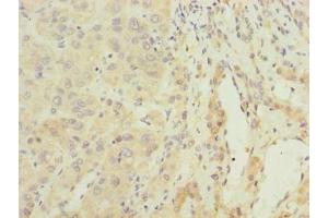 Immunohistochemistry of paraffin-embedded human liver cancer using ABIN7144623 at dilution of 1:100 (ARMCX2 anticorps  (AA 161-460))