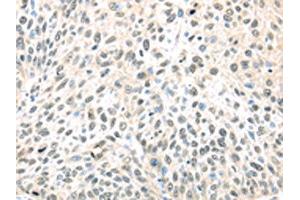 The image on the left is immunohistochemistry of paraffin-embedded Human lung cancer tissue using ABIN7128027(TCEB1 Antibody) at dilution 1/40, on the right is treated with fusion protein.