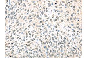 The image on the left is immunohistochemistry of paraffin-embedded Human lung cancer tissue using ABIN7128027(TCEB1 Antibody) at dilution 1/40, on the right is treated with fusion protein. (TCEB1 anticorps)