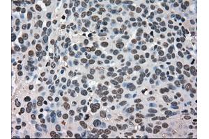 Immunohistochemical staining of paraffin-embedded Adenocarcinoma of breast tissue using antiHSPA9 mouse monoclonal antibody.