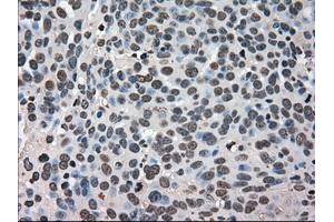 Immunohistochemical staining of paraffin-embedded Adenocarcinoma of breast tissue using antiHSPA9 mouse monoclonal antibody. (HSPA9 anticorps)