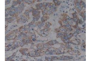 Detection of IkBb in Human Liver Tissue using Polyclonal Antibody to Inhibitory Subunit Of NF Kappa B Beta (IkBb) (Inhibitory Subunit of NF kappa B beta (AA 85-332) anticorps)