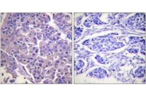 Immunohistochemistry analysis of paraffin-embedded human breast carcinoma tissue, using Caldesmon (Ab-789) Antibody. (Caldesmon anticorps  (AA 744-793))