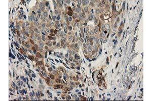 Immunohistochemical staining of paraffin-embedded Adenocarcinoma of Human breast tissue using anti-MAPRE2 mouse monoclonal antibody. (MAPRE2 anticorps)