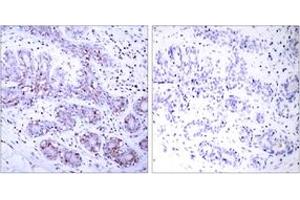 Immunohistochemistry analysis of paraffin-embedded human breast carcinoma tissue, using STAT4 (Ab-693) Antibody. (STAT4 anticorps  (AA 660-709))