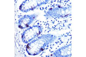 Immunohistochemistry of paraffin-embedded human colon carcinoma using Zinc-α2-glycoprotein (ZAG/) Rabbit mAb (ABIN7265556) at dilution of 1:100 (40x lens). (AZGP1 anticorps)