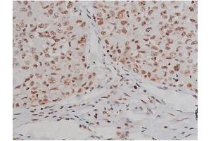ABIN6267336 at 1/200 staining Human lung cancer tissue sections by IHC-P.
